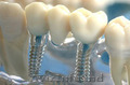 Стоматологические услуги,  имплантация зубов !!!