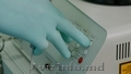 Лазерное лечение оникомикоза грибок ногтей в Кишиневе,  Молдове!